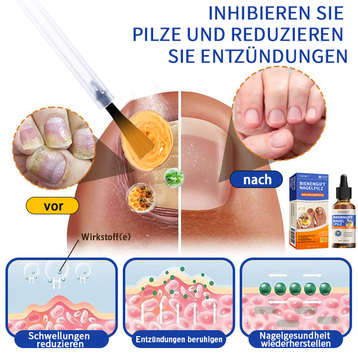 🌟🌟Furzero™ méhméreg körömgomba kezelési megoldás:Teljesen megoldja a körömgomba problémát🐝🐝