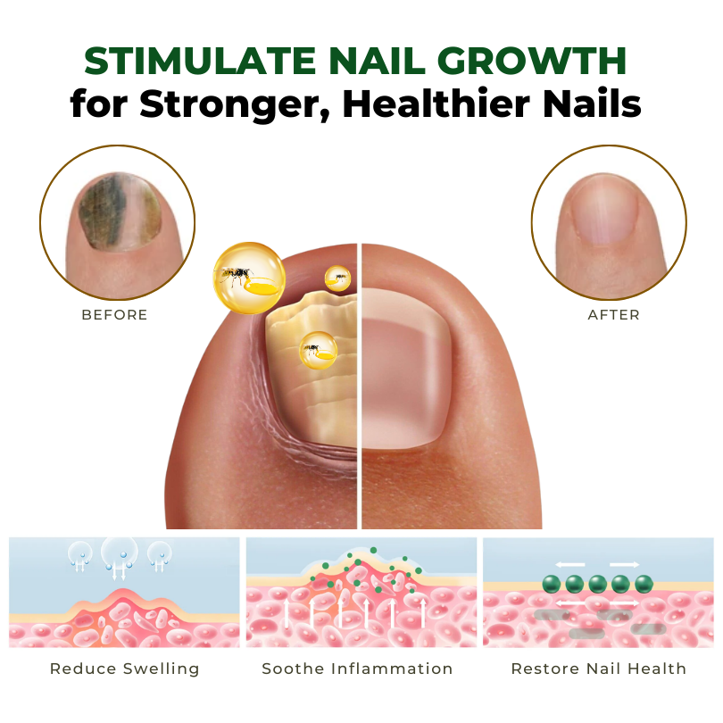 Biancat™ NailNurture Méhméreg Gombakezelő Olaj -👨⚕️ Az Amerikai Bőrgyógyászati Akadémia (AAD) által jóváhagyott termék.