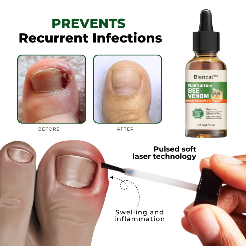 Biancat™ NailNurture Méhméreg Gombakezelő Olaj -👨⚕️ Az Amerikai Bőrgyógyászati Akadémia (AAD) által jóváhagyott termék.