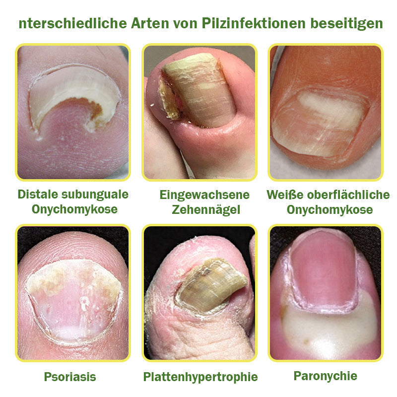 👩⚕️Furzero™ Nail Defense Bee Venom Treatment Serum (Mindenféle körömbetegségre✅Az egészségesebb körömnövekedésért)