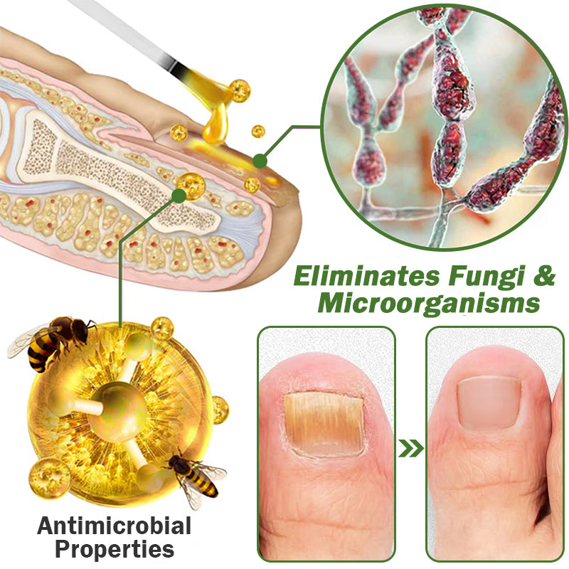 👩⚕️Furzero™ Nail Defense Bee Venom Treatment Serum (Mindenféle körömbetegségre✅Az egészségesebb körömnövekedésért)