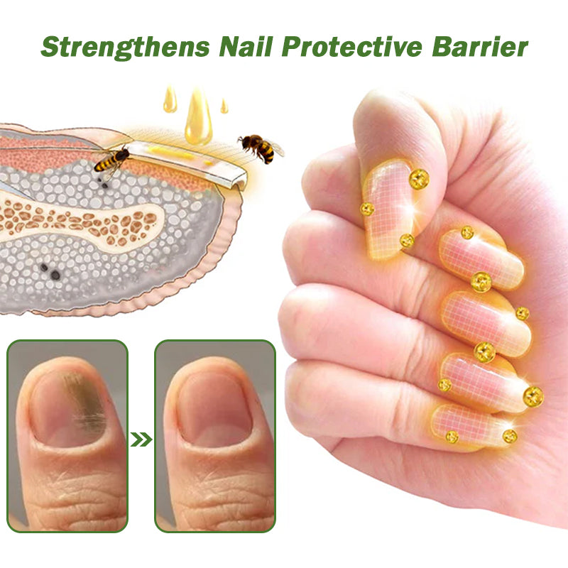 👩⚕️Furzero™ Nail Defense Bee Venom Treatment Serum (Mindenféle körömbetegségre✅Az egészségesebb körömnövekedésért)