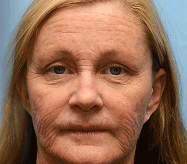 (đżđżKĂ©szĂŒlt Ă©s szĂĄllĂtott az EU-bĂłlâ
) - đ©ââïžFurzeroâą Botox mĂ©hmĂ©reg rĂĄnctalanĂtĂł krĂ©m-(UTOLSĂ NAP 70% LE)