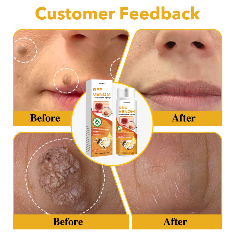 🐝Furzero™ méhméreg terápiás spray(✅Dermatest minősítés)