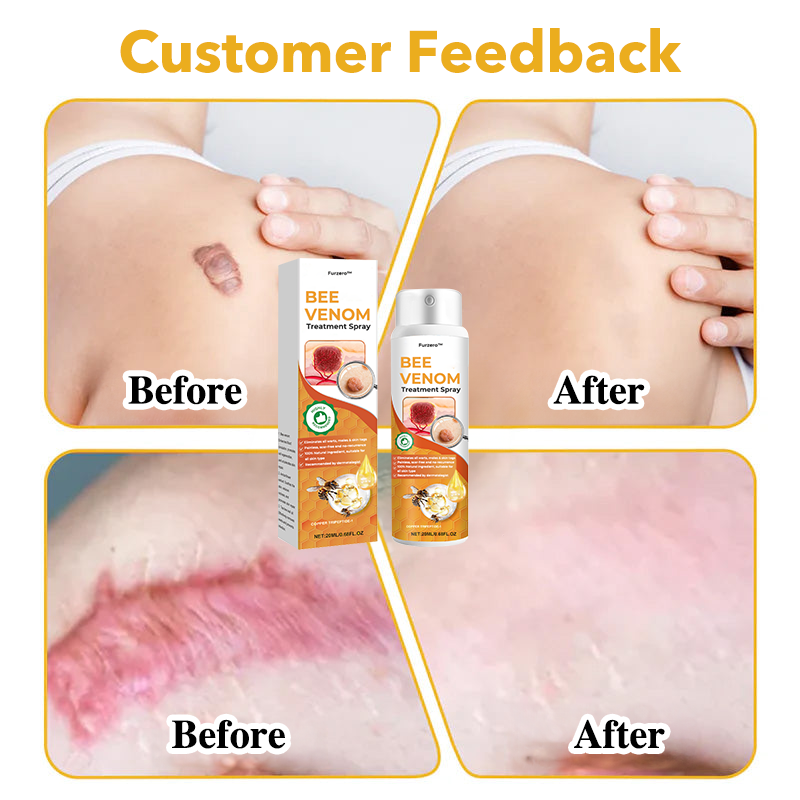 🐝Furzero™ méhméreg terápiás spray(✅Dermatest minősítés)