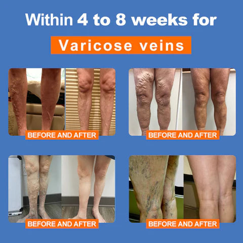 🔥🔥ANYIDEA™ Rádiófrekvenciás gyógynövényes termikus térdtámasz (High Leg Sleeves for Chronic Venous Insufficiency, Spider Veins & Duzzanat)
