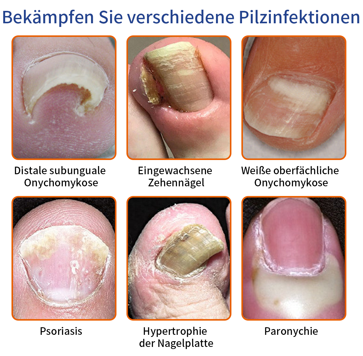 🐝🐝Furzero™ méhméreg körömgomba kezelési megoldás:Teljesen megoldja a körömgomba problémát🌟👣