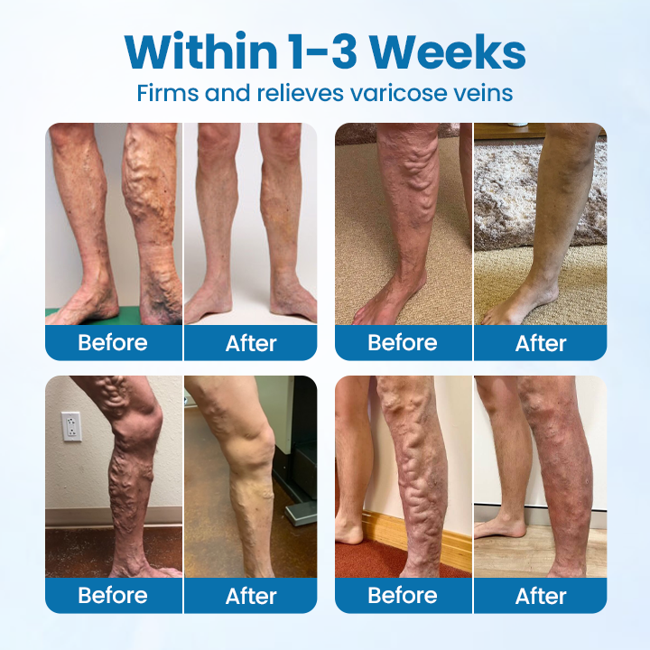 Timilk® VeinGuard Herbal Spray-✅ Klinikailag bizonyítottan 7 nap alatt megszünteti a visszerességet!