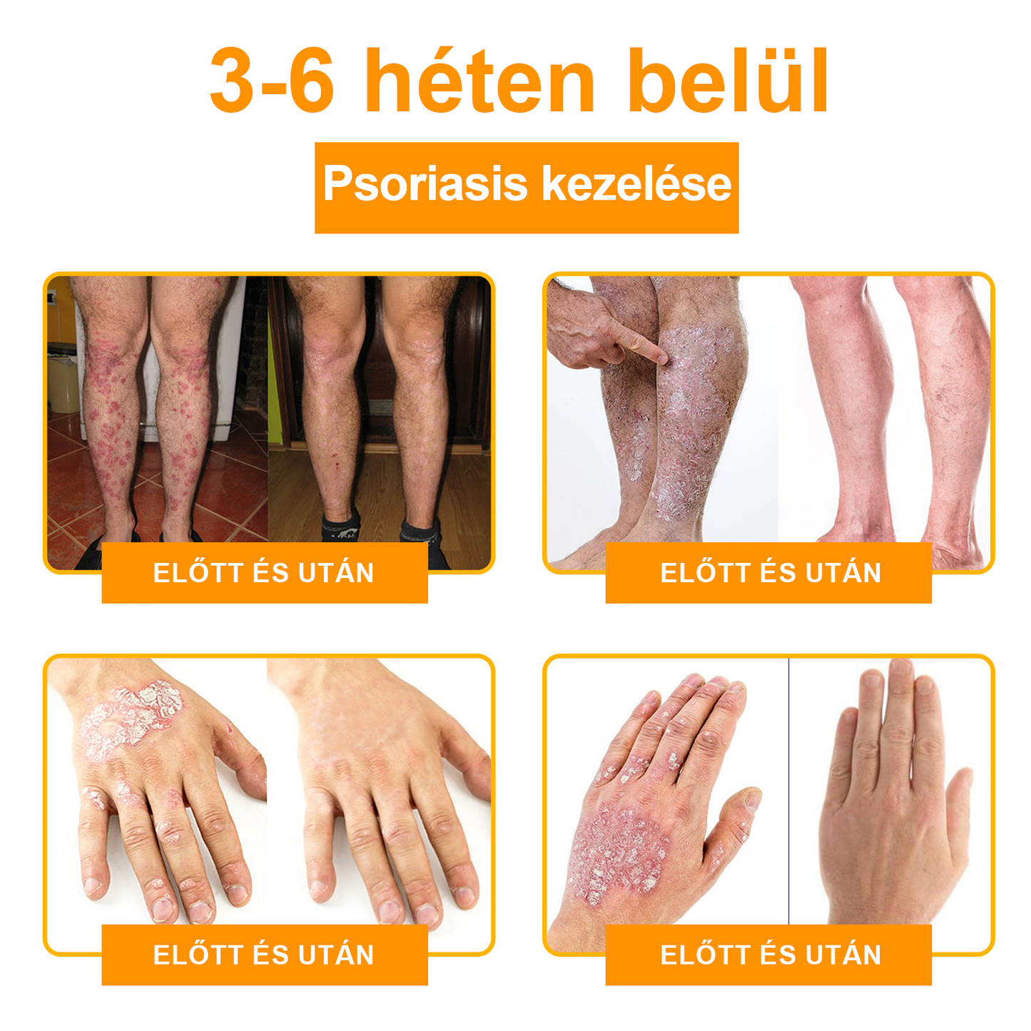 🌿[✨Hivatalos Márka Bolt✨] WartGone™ Gyógynövényes és szemölcskezelő krém (👨‍⚕️Orvosok ajánlása)