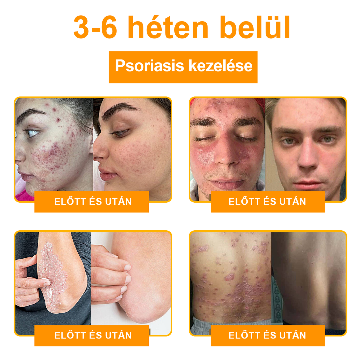 🌿[✨Hivatalos Márka Bolt✨] WartGone™ Gyógynövényes és szemölcskezelő krém (👨‍⚕️Orvosok ajánlása)