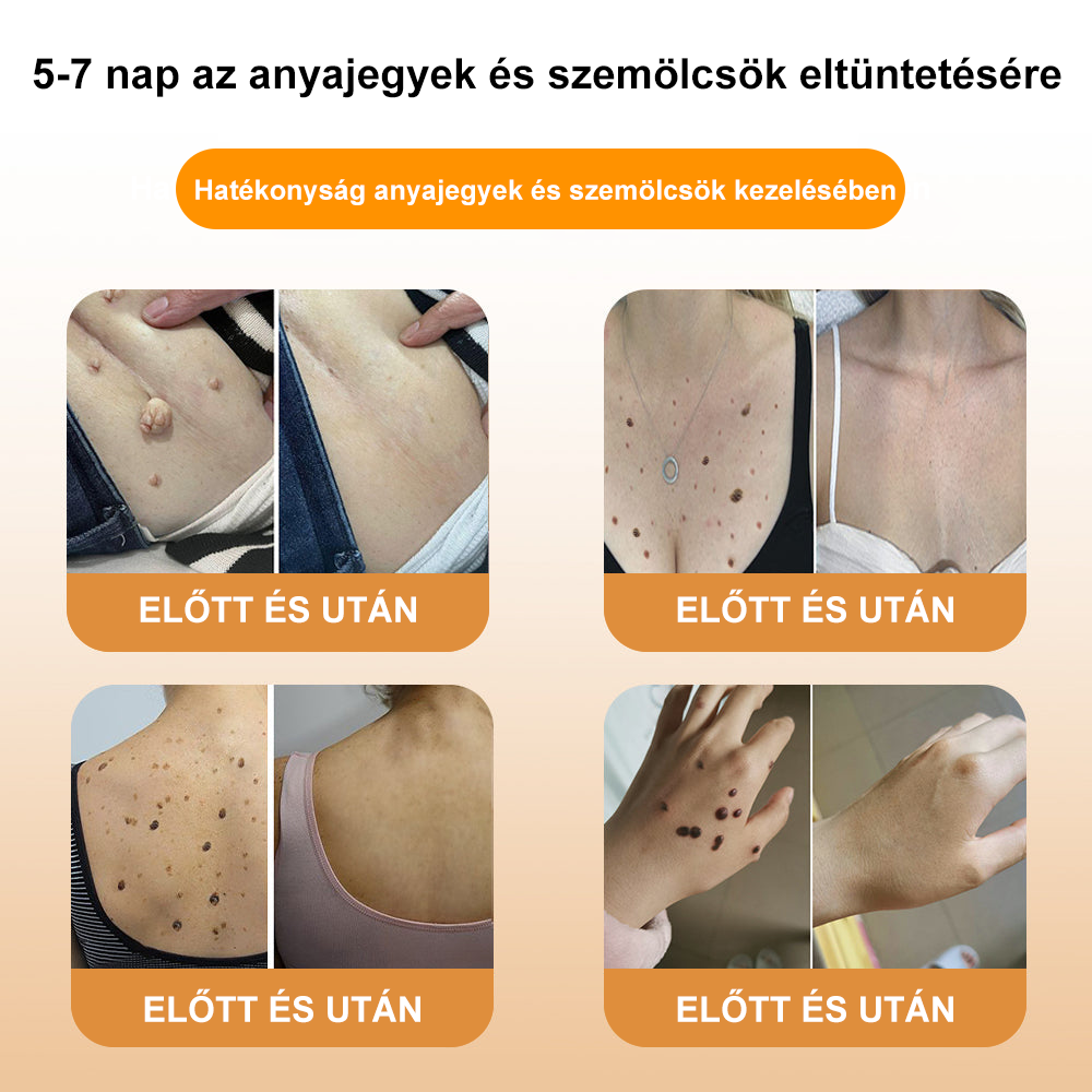 🌿[✨Hivatalos Márka Bolt✨] WartGone™ Gyógynövényes és szemölcskezelő krém (👨‍⚕️Orvosok ajánlása)