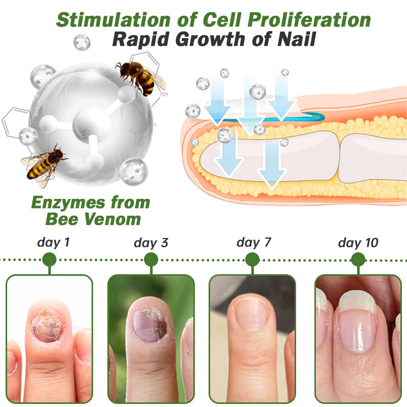 👩‍⚕️Furzero™ Nail Defense Bee Venom Treatment Serum (Mindenféle körömbetegségre✅Az egészségesebb körömnövekedésért)